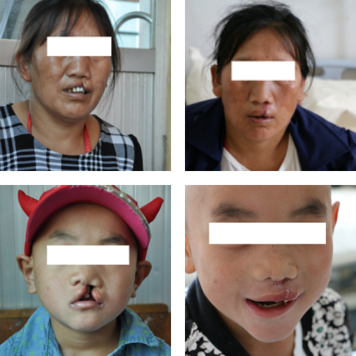 Patients who came from remote villages, before and after their cleft lip surgery.