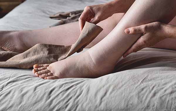 Lipedema, a heavy burden to bear