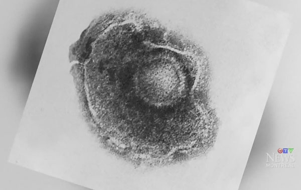 Should Quebec expand free shingles vaccination to more people?