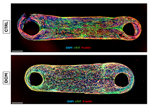 Microscopic images comparing the engineered cardiac tissues created from cells from a healthy participant (CTRL, top) and a patient with dilated cardiomyopathy (DCM, bottom).
