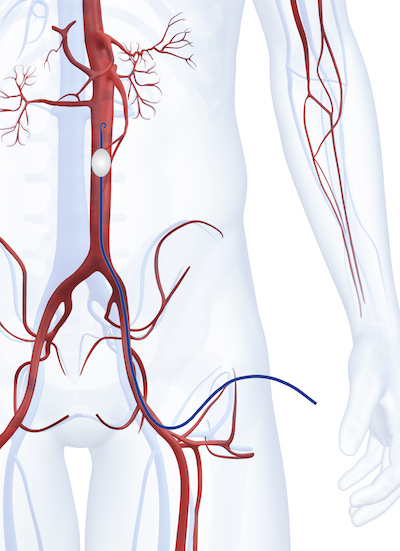 The ER-REBOA™ Catheter