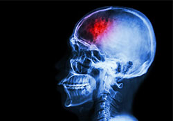 Timely treatment vastly improves outcomes for stroke patients