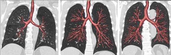 Figure 1. These CT scans of airways (red) and lungs (dark grey) show the spectrum of dysanapsis