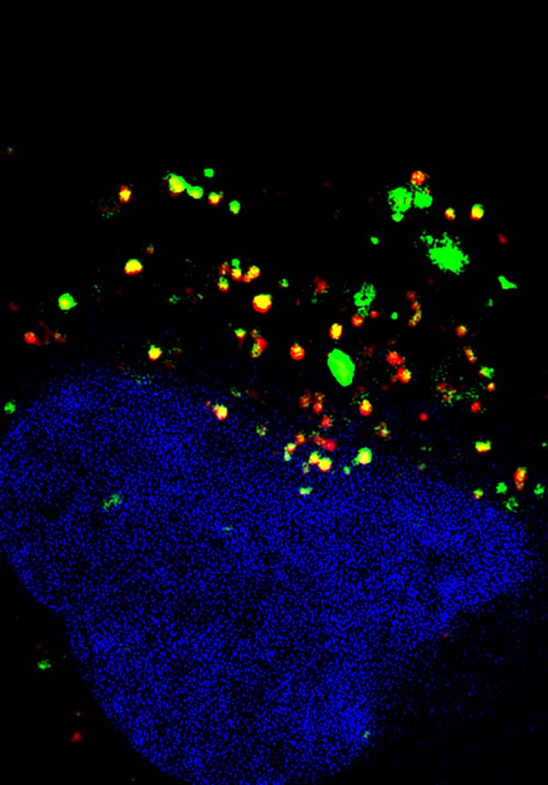 Brain cancer cell (nucleus in blue) receives messages from two other cells via EVs (in green and red).