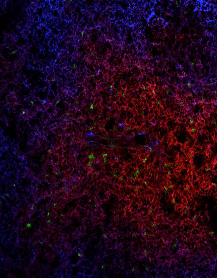 The image shows a lymph node in which we see normal T cells (in red) and Treg cells regulated by  the FOXP3 gene (in green).