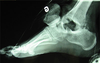 Foot X-Ray showing a fracture of the ankerbone