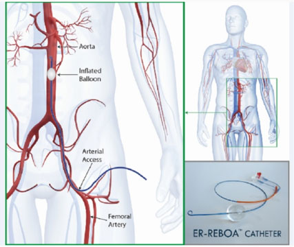 A first in Canada for a new technique in surgical emergencies